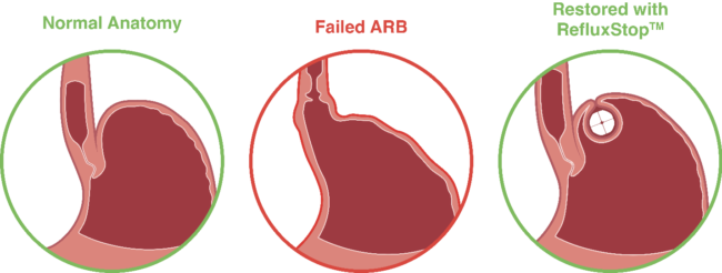 RefluxStop restoration